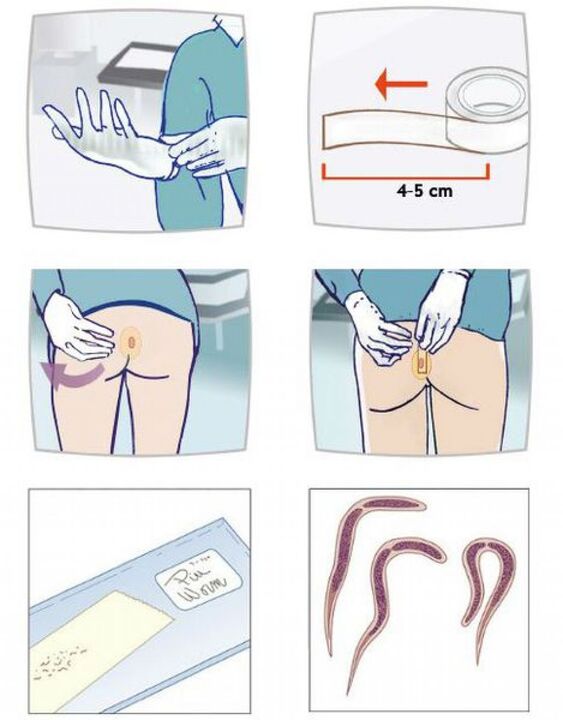 odběr vzorků stolice pro testování parazitů